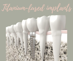 Dental implants diagram