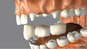 Dental bridge