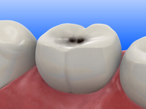 tooth cavity