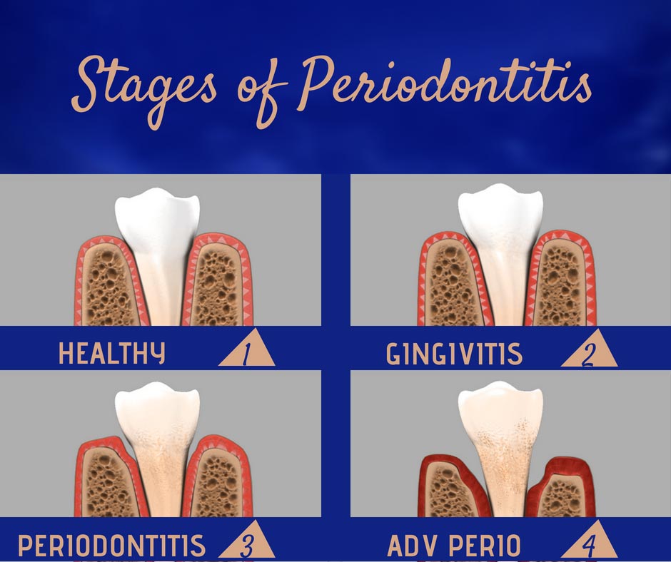 stages of periodontitis